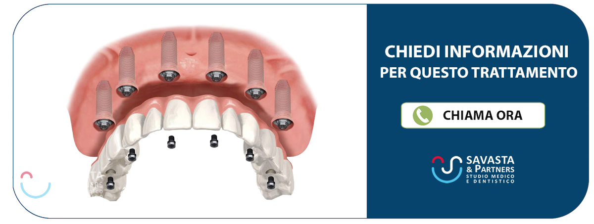 “implantologia-all-on-six-cagliari“